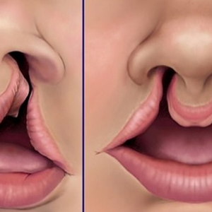 The Role of Speech Therapy in Post-Surgical Cleft Lip Recovery