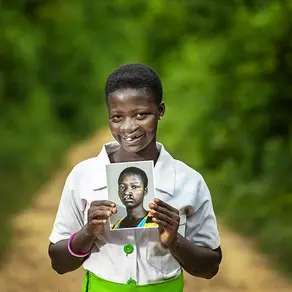 Visible Scars, Invisible Struggles: Cleft Lip Across Borders