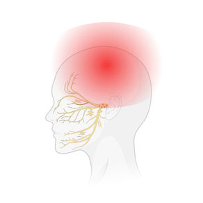 How Childhood Trauma Links to Chronic Migraines in Adulthood