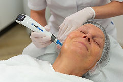 Microneedling bij Huidkliniek Bilthoven