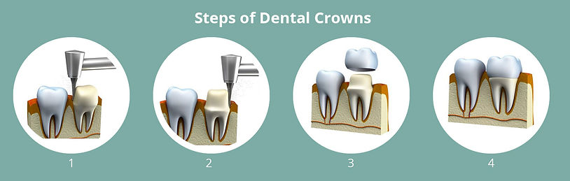 Steps-of-Dental-Crowns.jpg