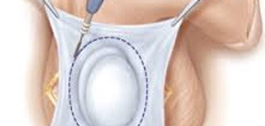 IDROCELE3.jpg