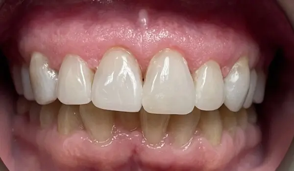 after-treatment-bright-healthy-teeth.webp
