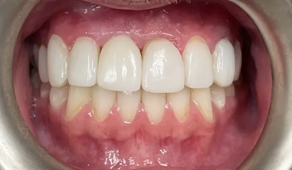 after-dental-treatment-tooth-restored.webp