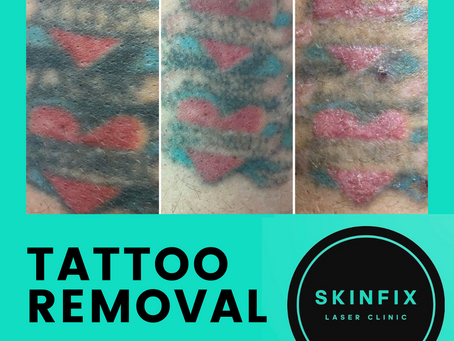How does laser tattoo removal actually work???