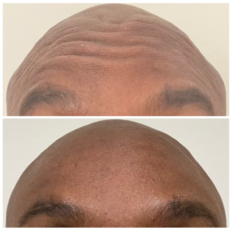 Thumbnail: MEN Anti-Wrinkle Injectables