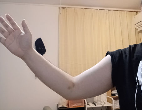 腕で見る山鹿・治らない骨折