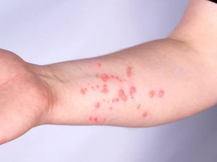 Urgente: Lorena registra primeiro caso de Mpox em 2024