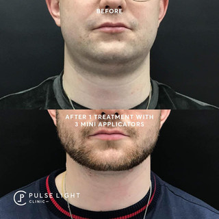 Fat Freezing Double Chin