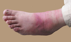 Severe burn healing process