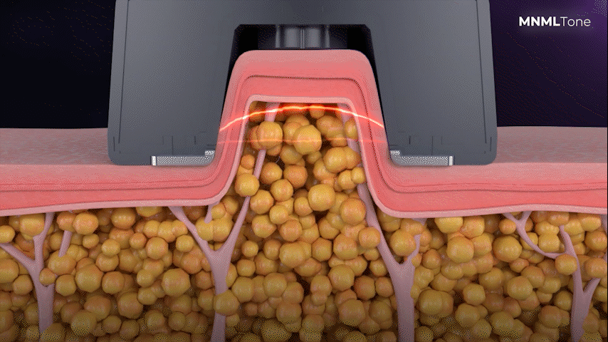 Radiofrequency