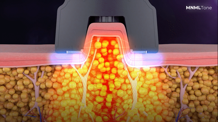 Cooling Preventing Burns & Pain from the Heat of RF
