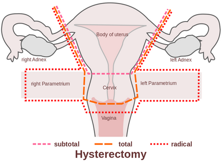 Hysterectomy