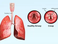 Managing Croup in Young Children - for Barky Coughs and Midnight Worries