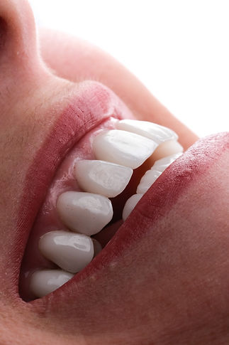 Lentes de Contato Dentárias