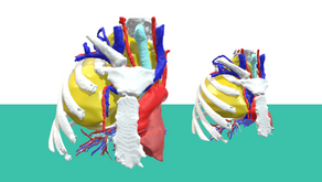Cáncer de pulmón: Complementando el abordaje robótico con planificación 3D