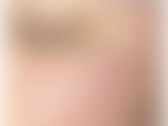 A female with acne