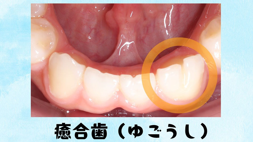 癒合歯