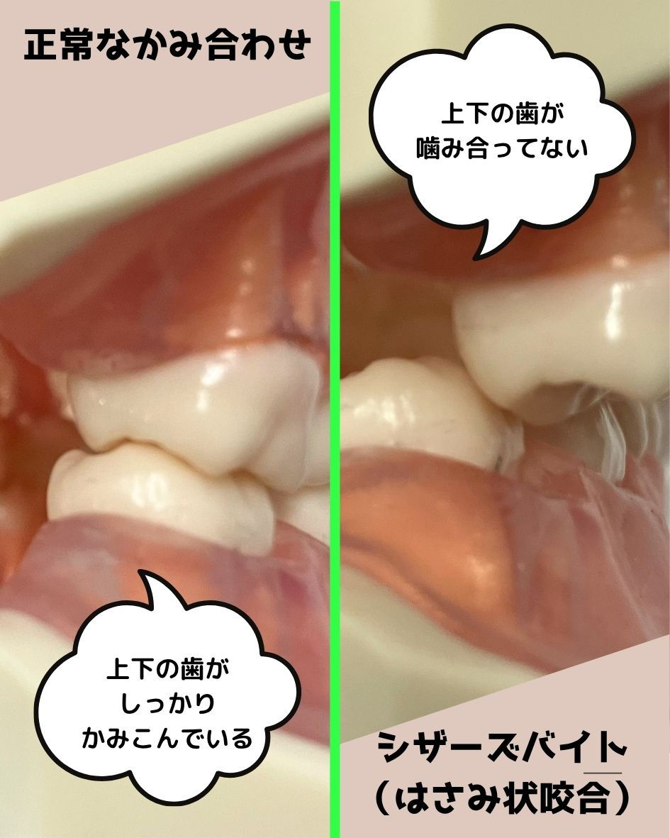 はさみ状咬合