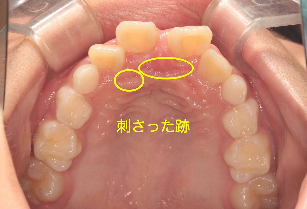 過蓋咬合は歯並びの異常だけではなく外傷の原因にもなりうるため歯科矯正が必要である。
