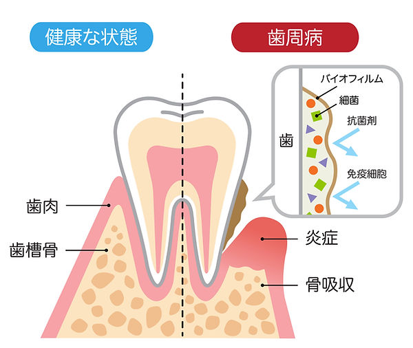 歯周病