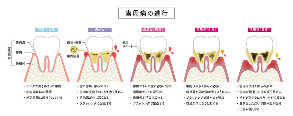 歯周病の進行