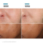 縮圖：PCF 無瑕煥白抗氧化精華 修麗可 skinceuticals phloretin cf 淡斑 美白 膚色均勻 光澤感 前後對比 效果 活動 優惠 折扣 免運費 蓮華皮膚科 醫美 診所 台中 台灣