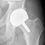 Thumbnail: Hip Resurfacing