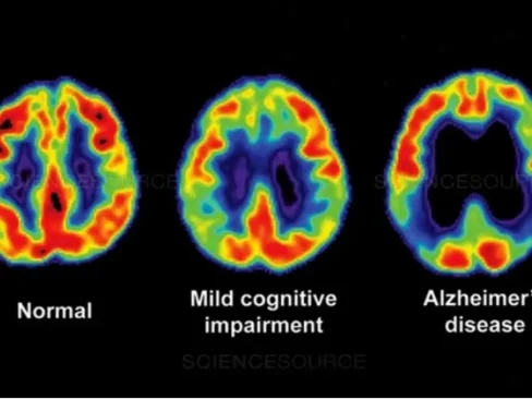 Alzheimers brain scan