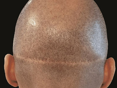 Common FUT surgery scar_edited.jpg