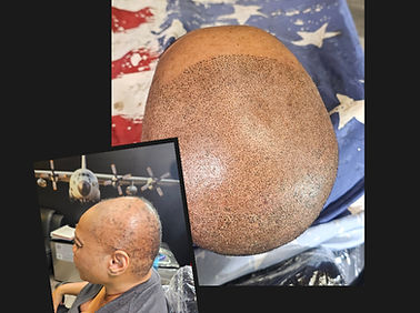 Alopecia hair density restoration