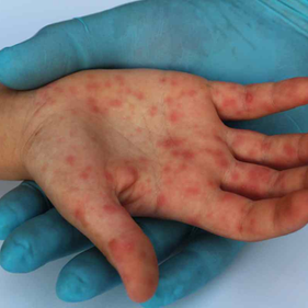 Brote de sarampión activo supera los 15 mil casos y causa 36 muertes.