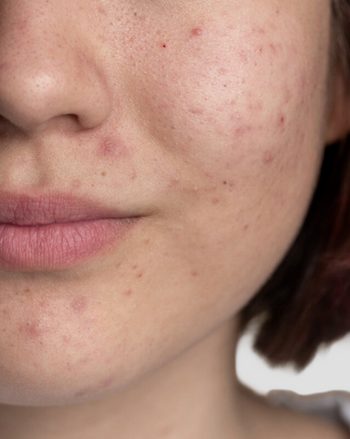 Close-up image of acne-prone skin with visible congestion and breakouts.