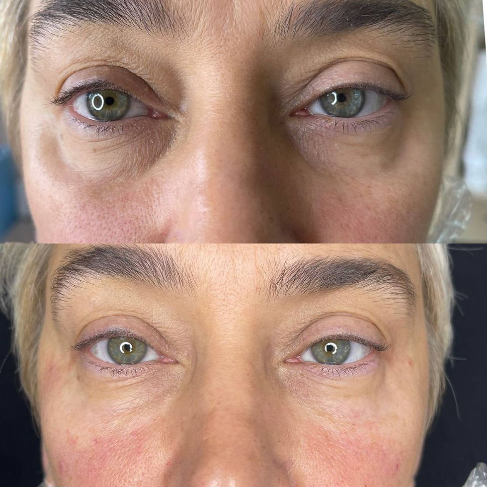Under Eye Filler