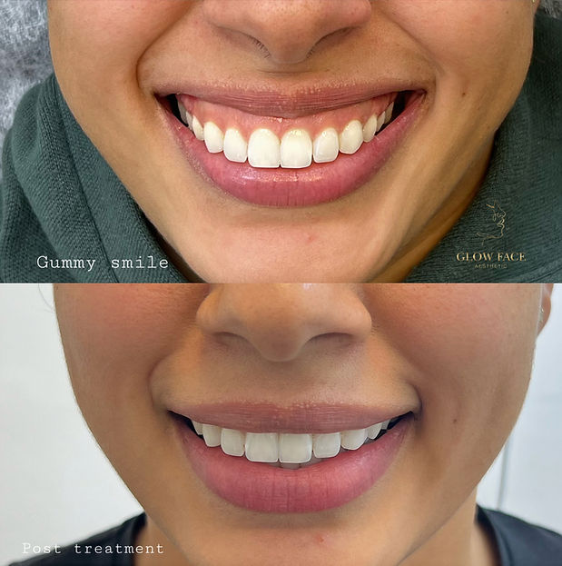 GUMMY SMILE BEFORE AND AFTER AT GLOW FACE AESTHETIC KINGS CROSS LONDON