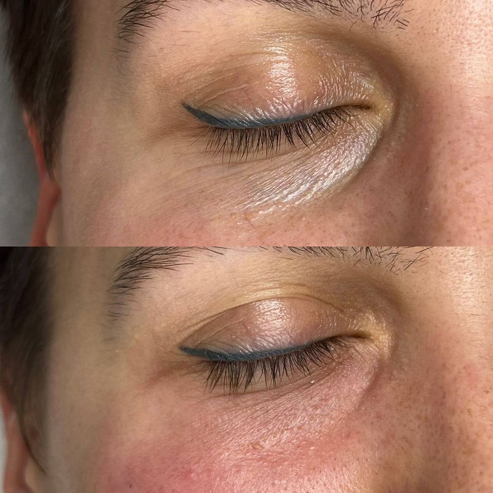 Under Eye Filler