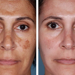 melasma treatment