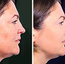 skin peel results