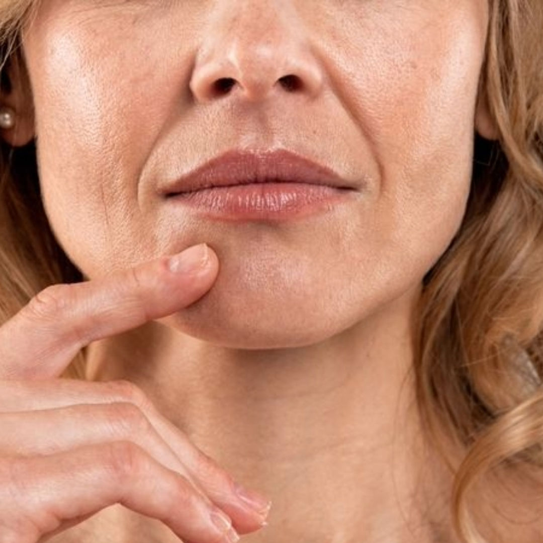 Dermal Filler face contouring, facial volume restoration