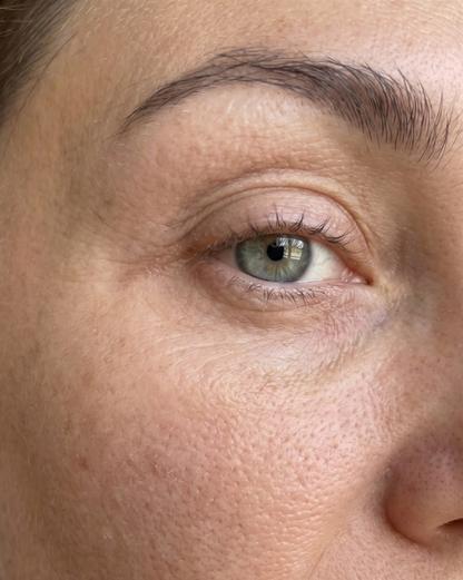 Close-up of the under-eye area showing hollowness and dark circles
