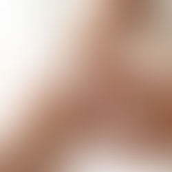 A person rubbing topical lotion on forearm.