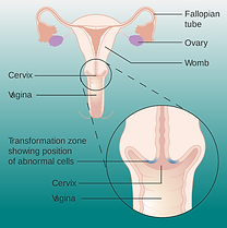 cervical cancer