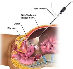 Endometrial Hyperplasia Treatment