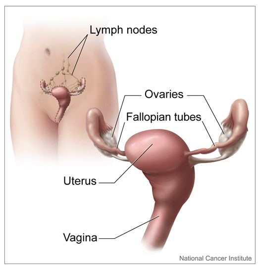 Ovarian cancer