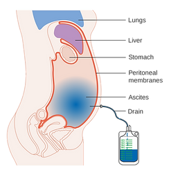 2000px-Diagram_showing_fluid_(ascites)_b