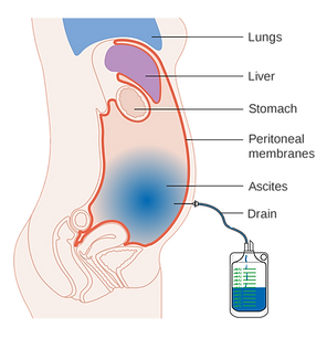 ovarian neoplasm symptoms