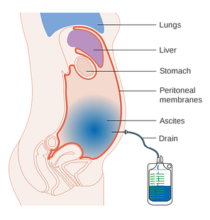 2000px-Diagram_showing_fluid_(ascites)_b