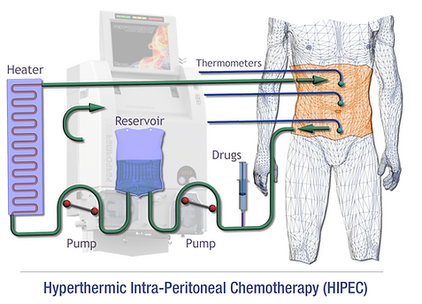 peritoneal adenocarcinoma