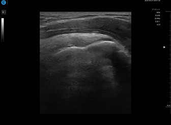 肩腱板エコー症例画像