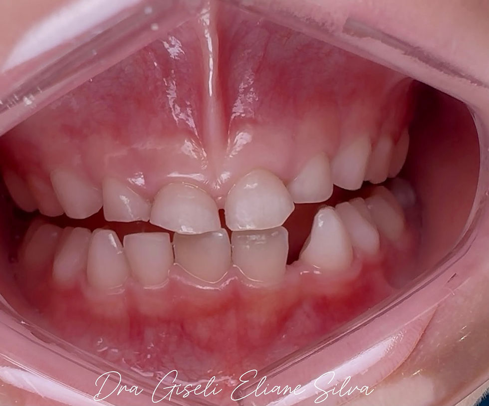Sinais de desgaste dentário associados ao bruxismo infantil.